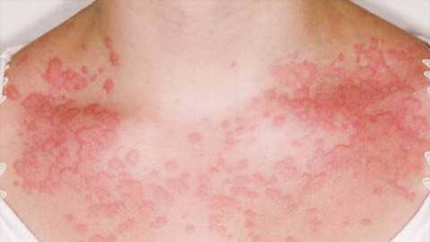 Аллергический контактный дерматит