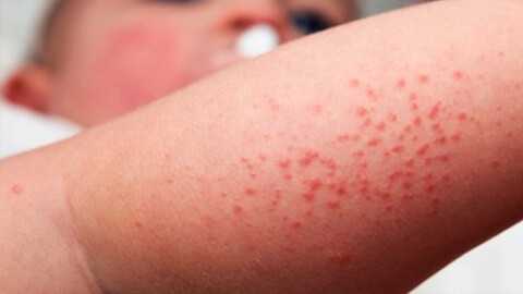 Аллергический контактный дерматит, атопический