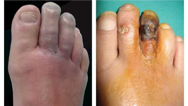 Потемнение кожного покрова