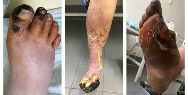 Распространение сухой гангрены