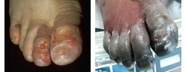 Влажная гангрена