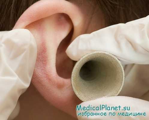 поражения слуха при сифилисе