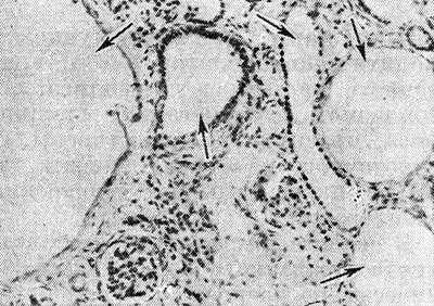 Рис. 2. Микропрепарат коркового слоя почки мертворожденного плода: кисты указаны стрелками.