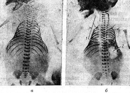 Рис. 3. Рентгенограммы мертворожденного плода: а — полное отсутствие газа в грудной клетке и других полостях тела; б — наличие газа в полостях сердца и крупных сосудов (1), а также в желудке (2).