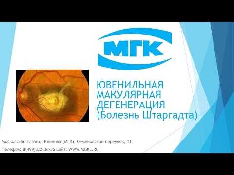 Видео Ювенильная макулярная дегенерация (болезнь Штаргардта)