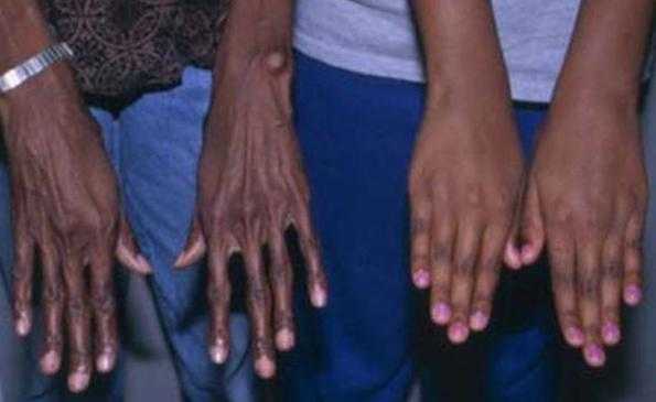 синдром Марфана тип наследования