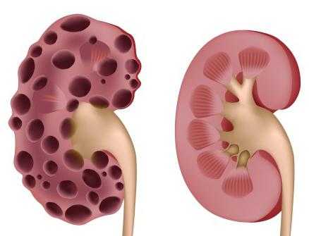 тип наследования аутосомно- доминантный это