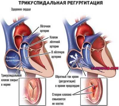 трикуспидальная-регургитация