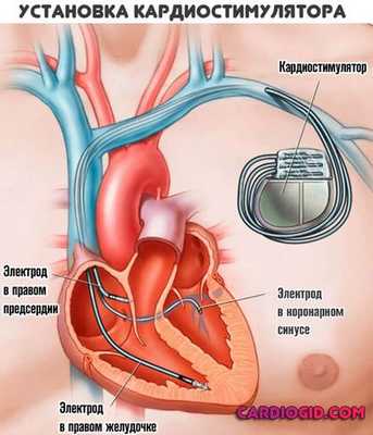 kardiostimulyator