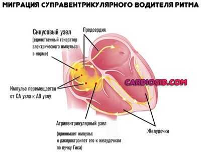 Миграция суправентрикулярного водителя ритма
