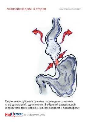 Ахалазия кардии. Классификация. 4-ая стадия развития