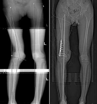 Рентгенография несовершенного остеогенеза