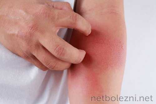 Лечение атопического дерматита