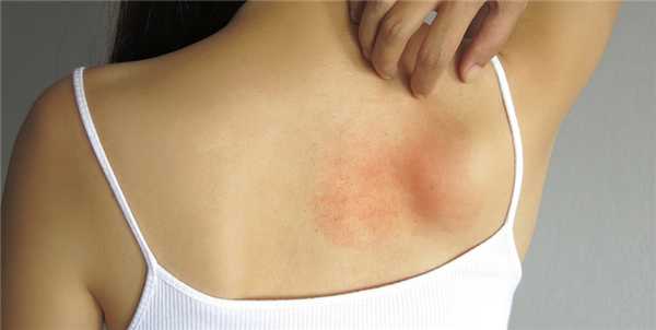 Лечение и уход за кожей при дерматите