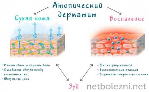 Проявление атопического дерматита