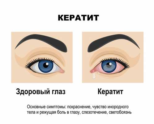 Кератит.jpg