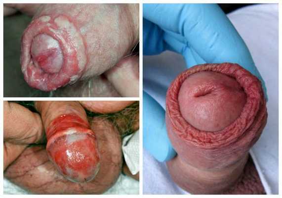 Признаки баланопостита