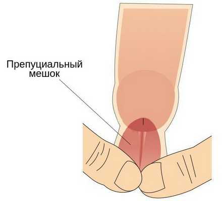 Препуциальный мешок