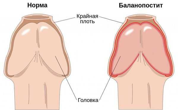 Головка и крайняя плоть: норма и воспаление