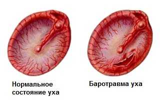 Осложнения из-за баротравмы уха