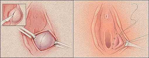 Марсупилизация при бартолините