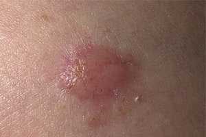 Узелково-язвенная базалиома