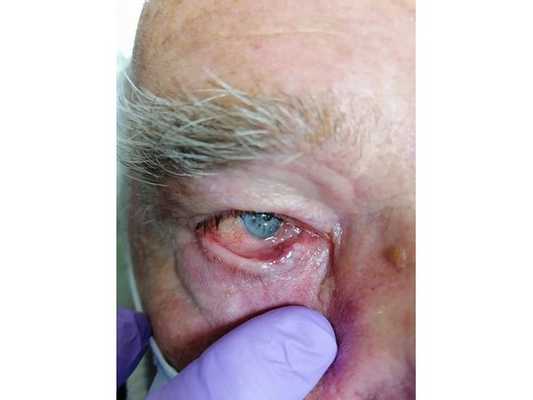 Пациент сразу после процедуры фотодинамической терапии