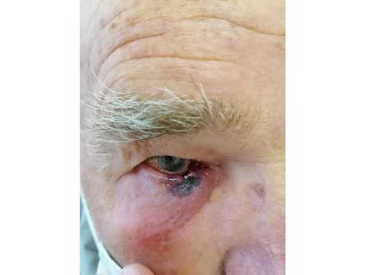 Результат через неделю после сеанса: границы опухоли увеличились