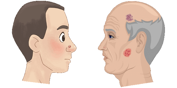 возраст - фактор развития базалиомы