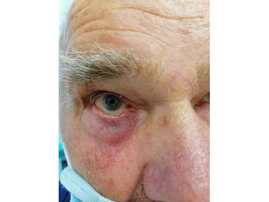 Результат через полгода лечения: опухоль не обнаруживается