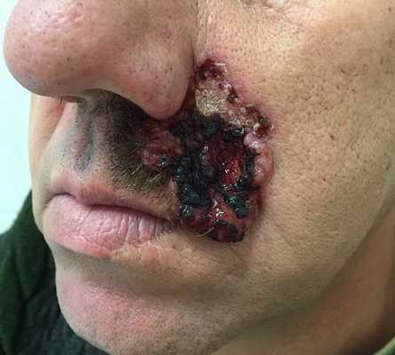 Виды базалиомы: инфильтративная