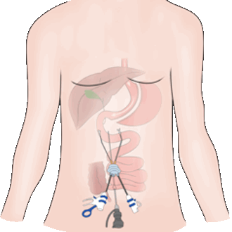 Послеоперационная грыжа