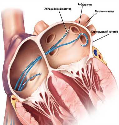 Ростов-на-Дону | Найден способ повысить эффективность лечения самой распространенной аритмии - БезФормата