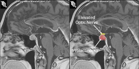 Пролактинома на МРТ с контрастированием