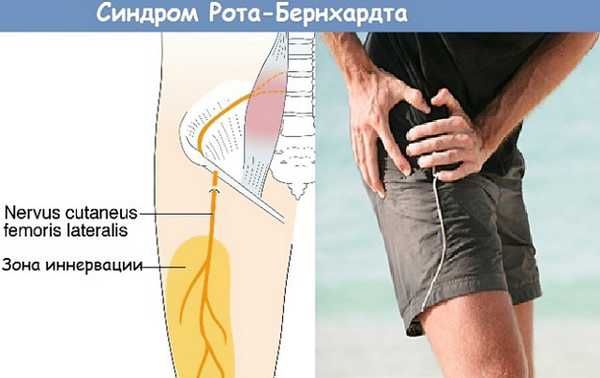 Болезнь Рота-Бернгардта
