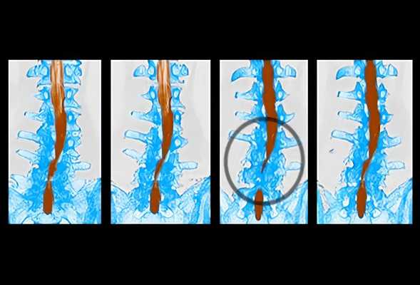 Спинальный стеноз