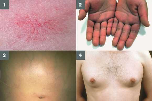 Симптомы цирроза печени