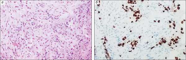 Рис. 4. Низкодифференцированная аденокарцинома легкого и положительная ИГХ-реакция с антителом к TTF-1 в ядрах опухолевых клеток («Природа» №6, 2018) 