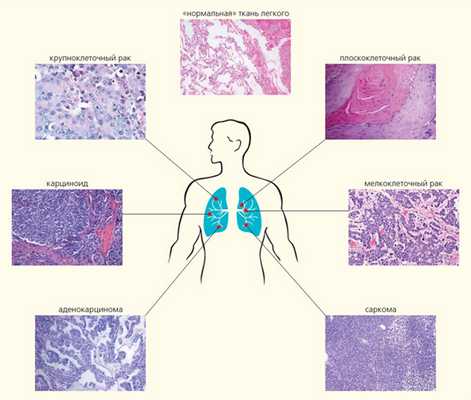 Рис. 2. Гистологические типы рака легкого («Природа» №6, 2018)