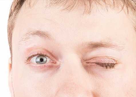 Блефароспазм