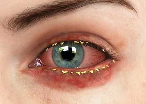 Блефарит глаз