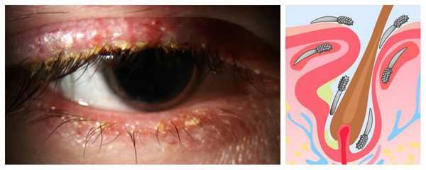 Поражение верхнего века клещом демодекс