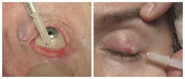 Интралезиональная стероидная инъекция 