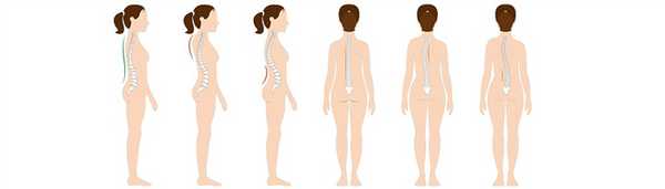 Боли в грудном отделе позвоночника могут быть из-за искривления