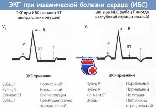 ЭКГ при стенокардии - ишемической болезни сердца