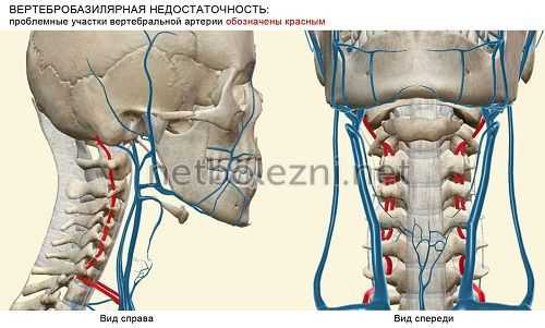 Вертебробазилярный синдром позвоночника