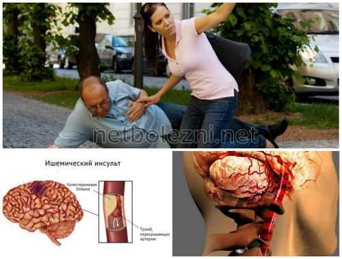 Ишемические гемодинамические дисфункции