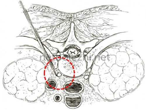 Как проводится симпатэктомия