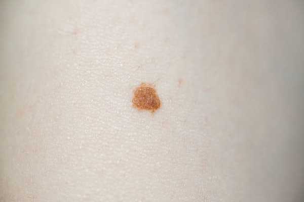 Болезнь Боуэна