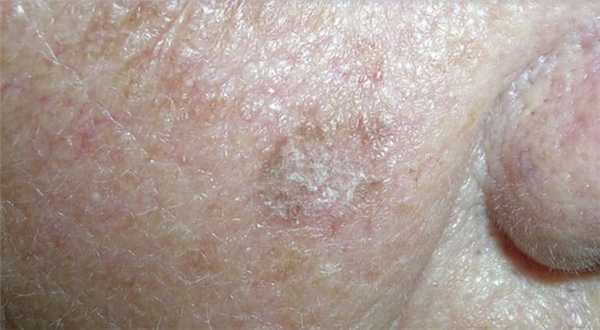 Болезнь Боуэна